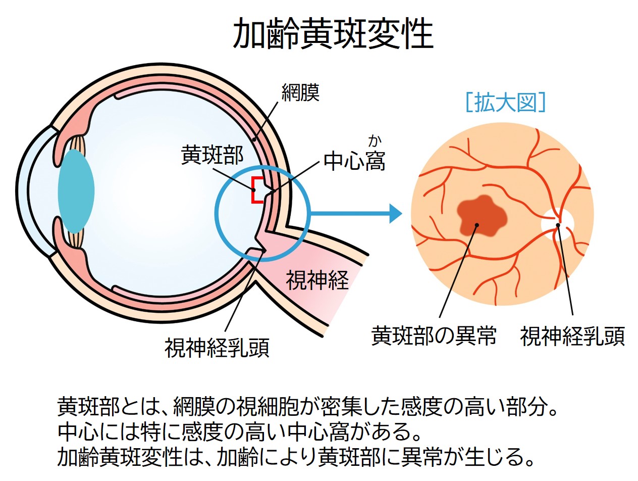 加齢黄斑変性