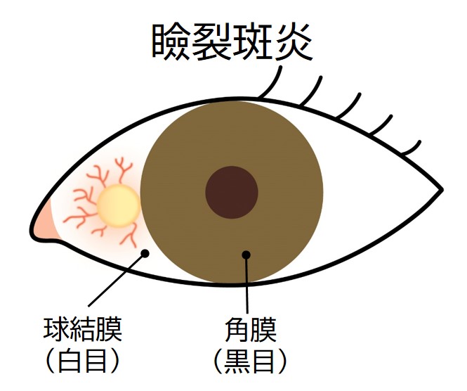 瞼裂斑炎