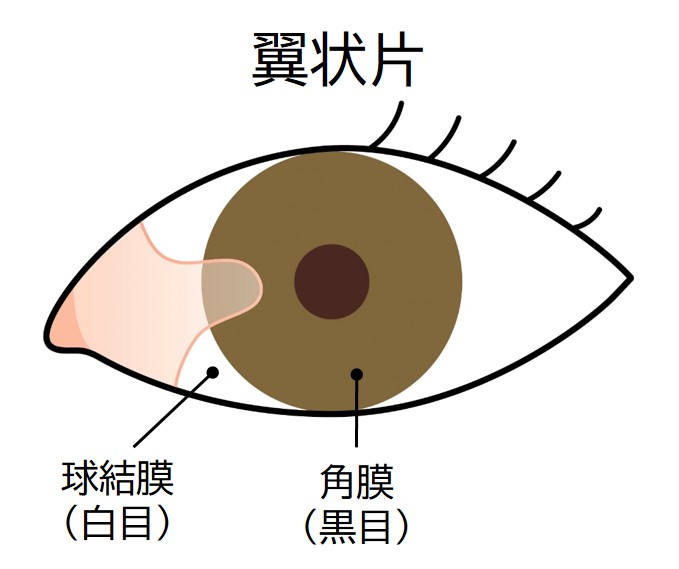 翼状片