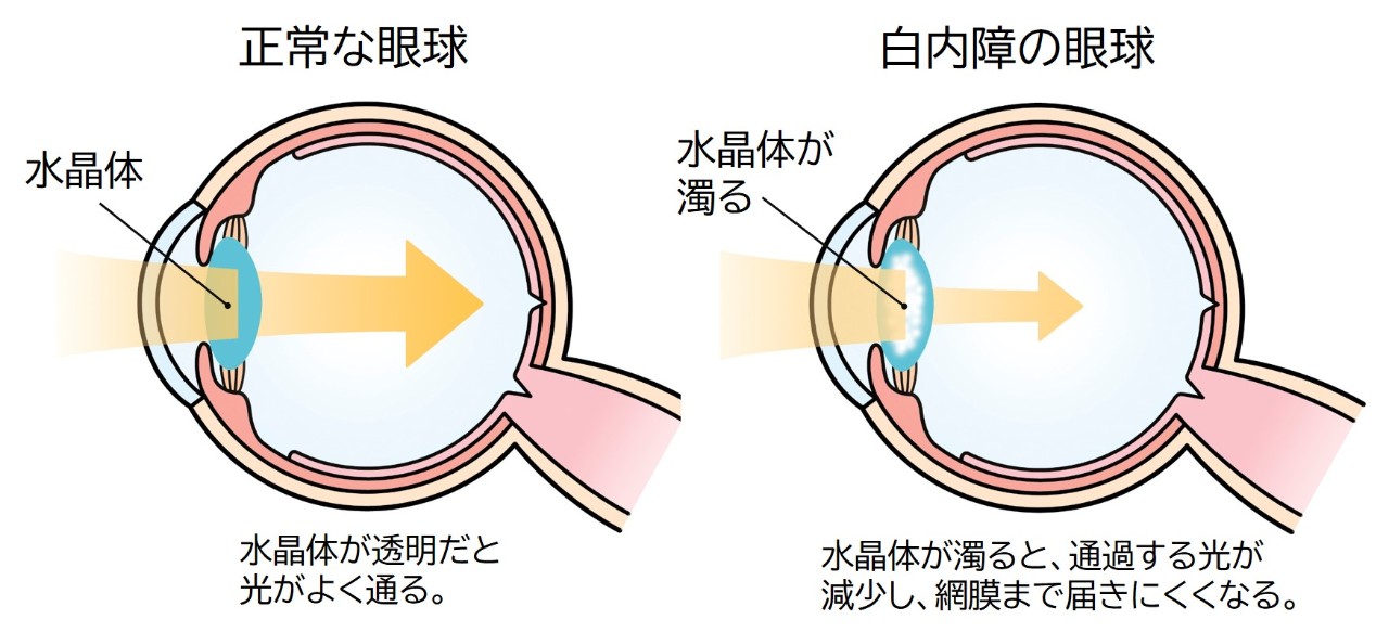 白内障