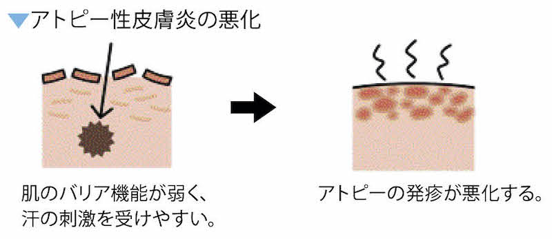 アトピー性皮膚炎の悪化