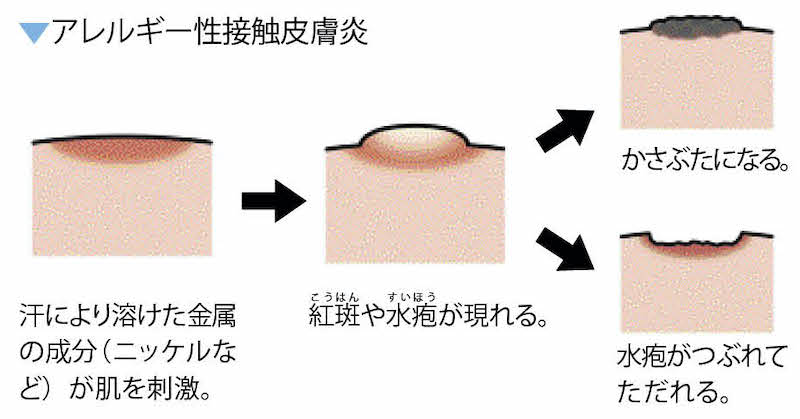 アレルギー性接触皮膚炎とは