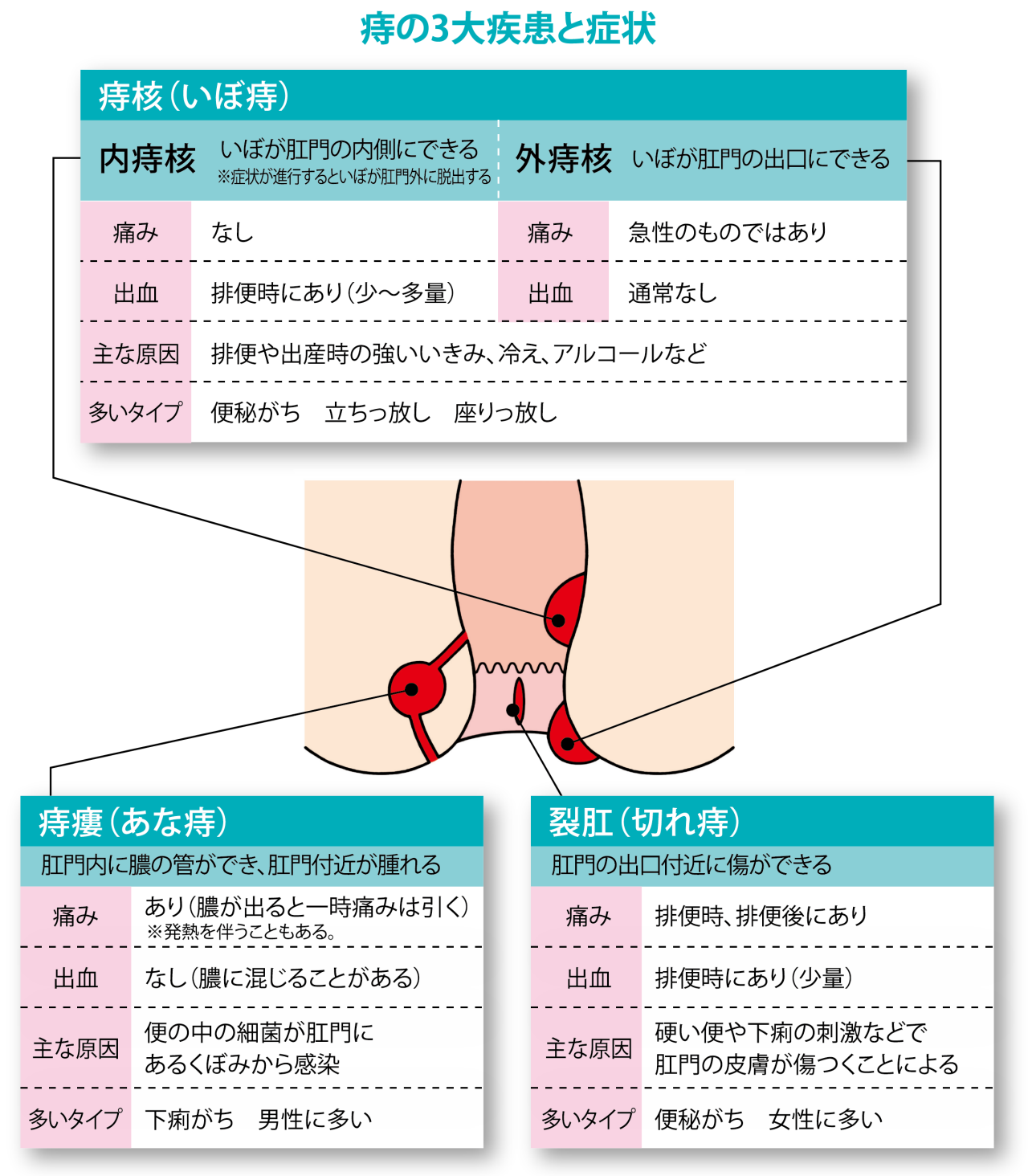 痔の３大疾患と症状