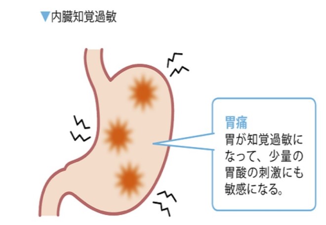 機能性ディスペプシアの原因と主な症状