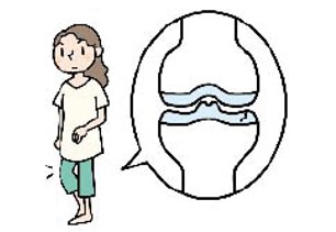 膝関節軟骨のすり減りと自覚症状