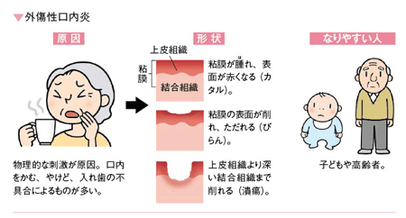 外傷性口内炎