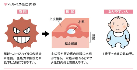 ヘルペス性口内炎