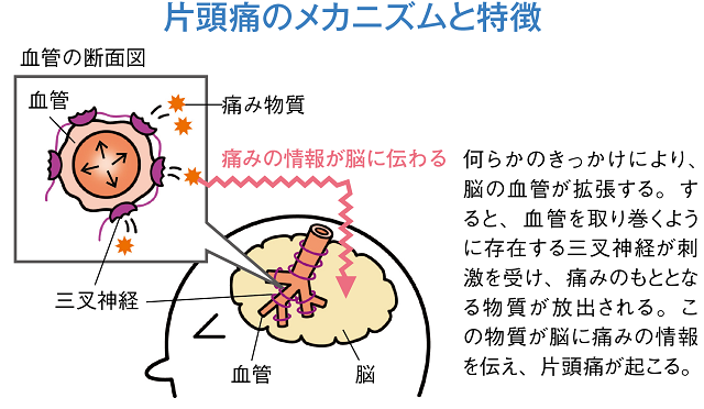 片頭痛のメカニズムと特徴