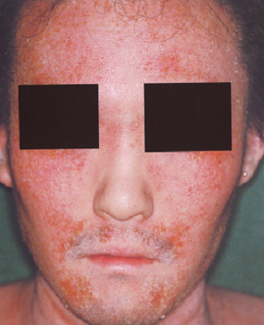 アトピー性皮膚炎の症状