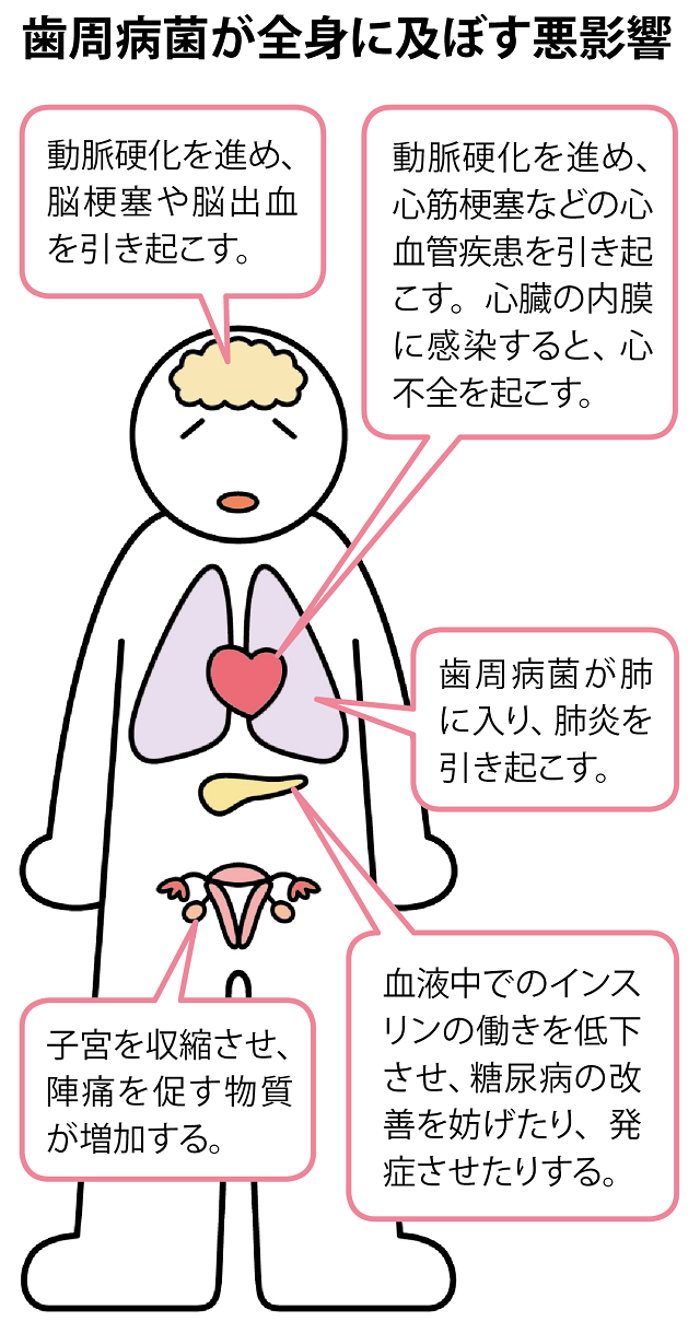 歯周病菌が全身に及ぼす悪影響