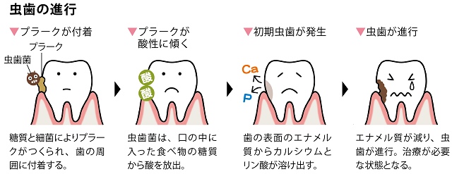 虫歯の進行