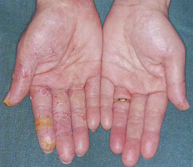 手湿疹（進行性指掌角皮症）