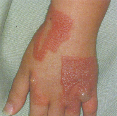 アレルギー性接触皮膚炎