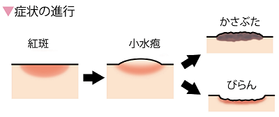 症状の進行