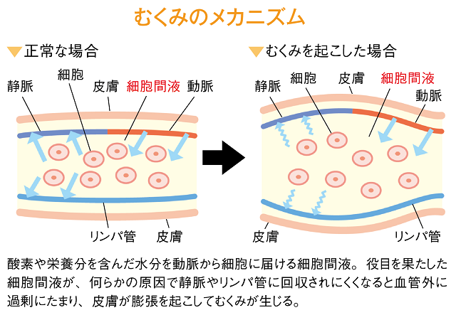 むくみのメカニズム