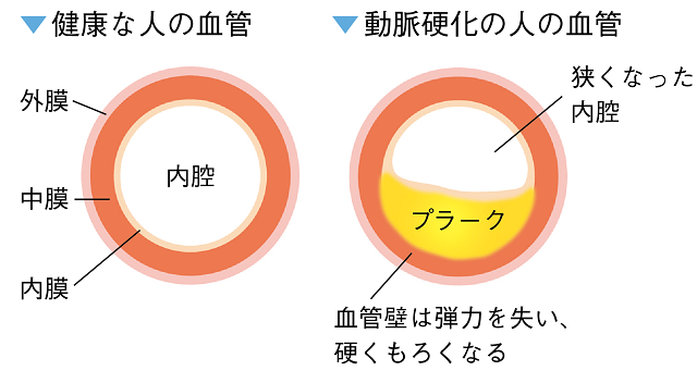 動脈硬化の進行４