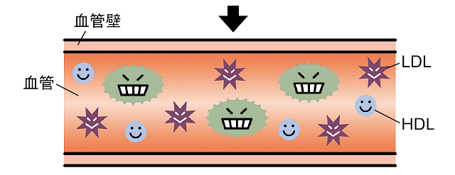 動脈硬化の進行２