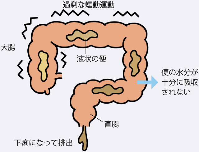 慢性下痢