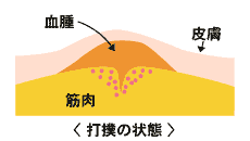 打撲の状態