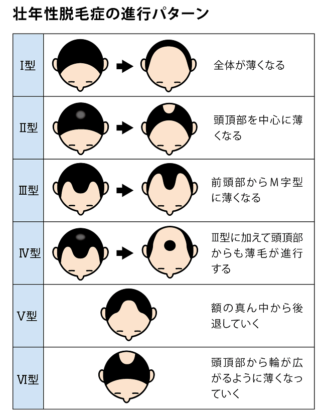 壮年性脱毛症の進行パターン