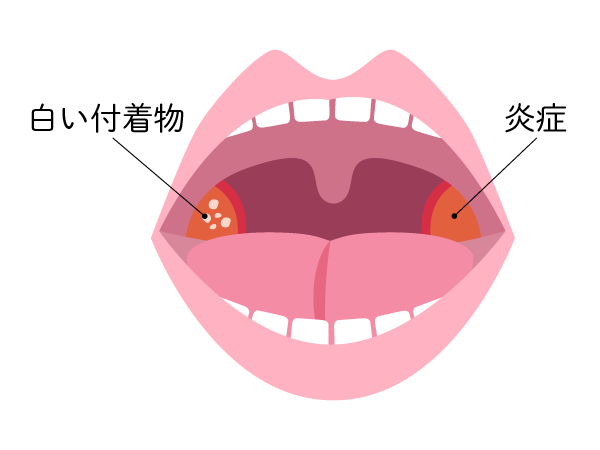 扁桃の炎症と白い付着物のイラスト