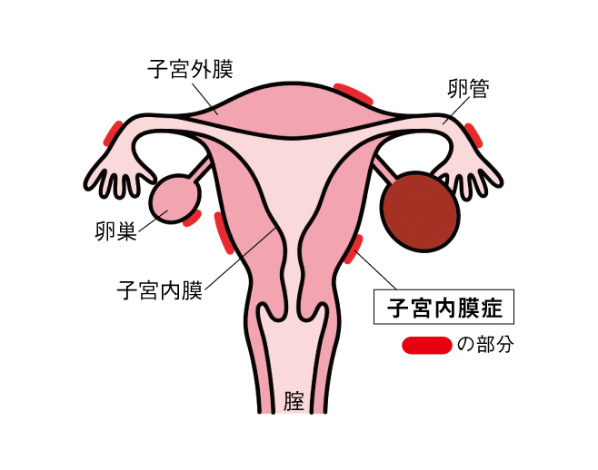 子宮内膜症