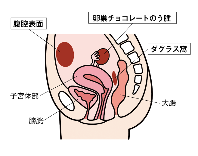 子宮内膜症のできる場所