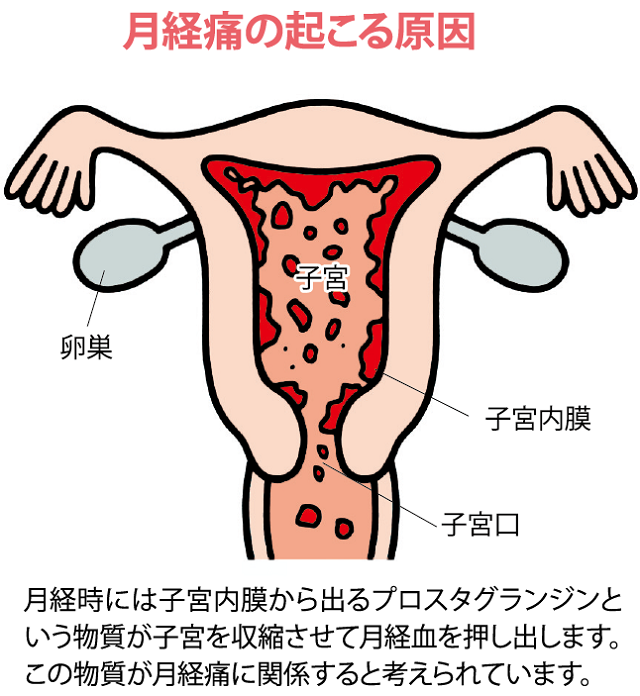 月経痛の起こる原因