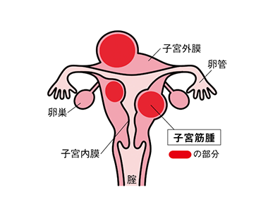 子宮筋腫