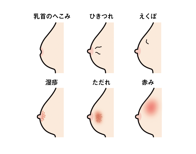 乳がんの症状