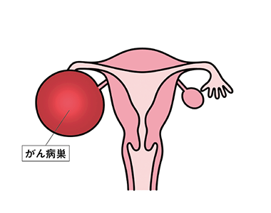 卵巣がんの進行２