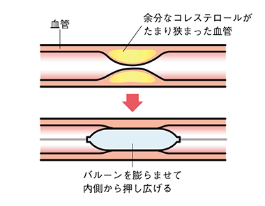 狭心症の治療