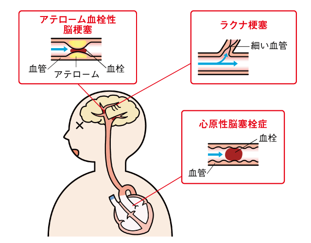 脳梗塞のタイプ