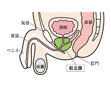 前立腺肥大症