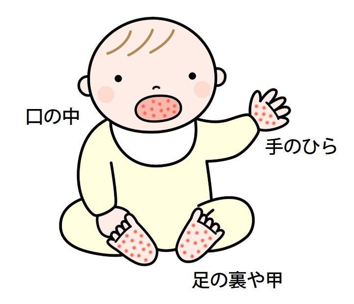 手足口病｜大正健康ナビ｜大正製薬