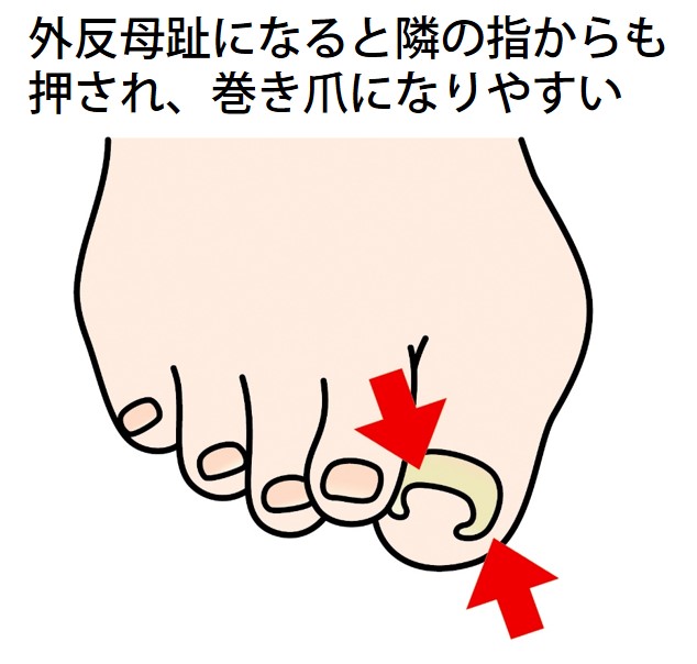外反母趾になると、隣の指からも押され、巻き爪になりやすい