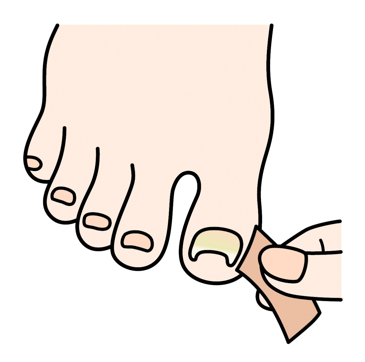 巻き爪の対策「テーピング法１」