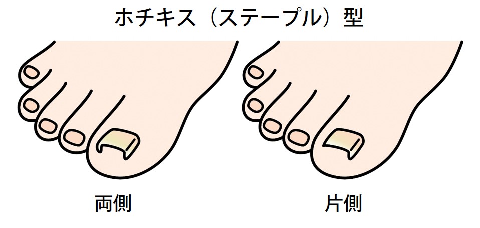 ホチキス（ステープル）型