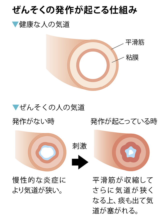 ぜんそくの発作が起こる仕組み