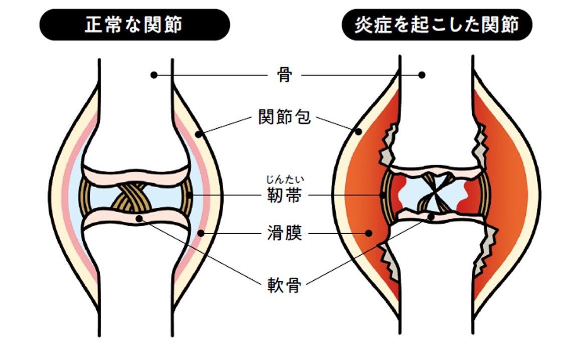 関節リウマチは滑膜の組織が攻撃され、炎症を起こすことで発症