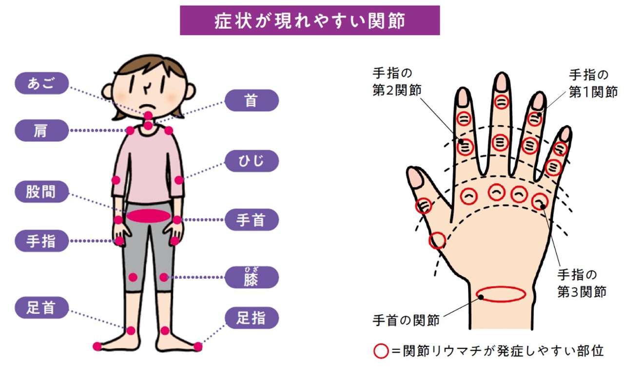 関節リウマチの症状が現れやすい関節