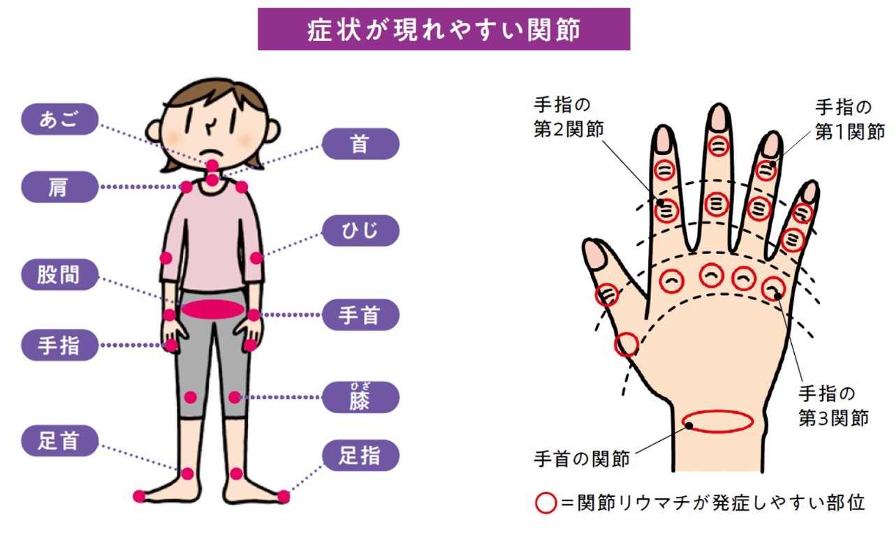 関節リウマチの最も一般的な発症年齢は何歳ですか?