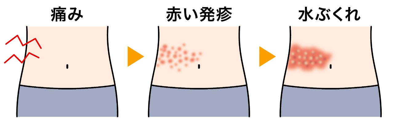 痛みや違和感の後に現れる帯状の発疹