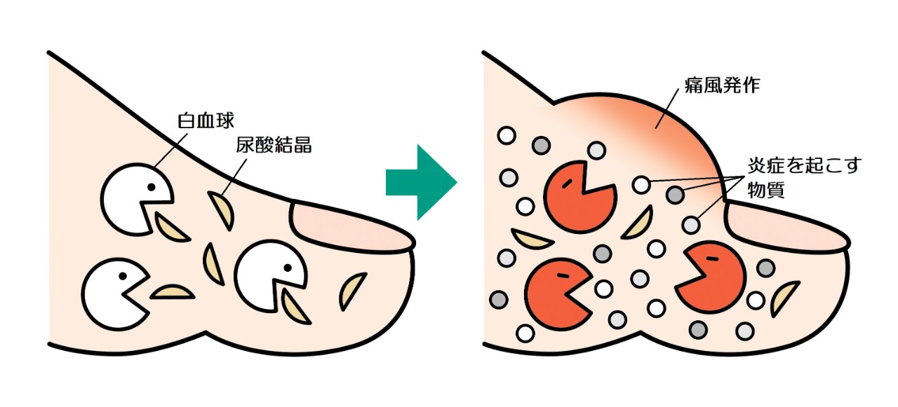 血液で増え過ぎた尿酸が関節で結晶化し、激しい痛みの痛風発作を起こす