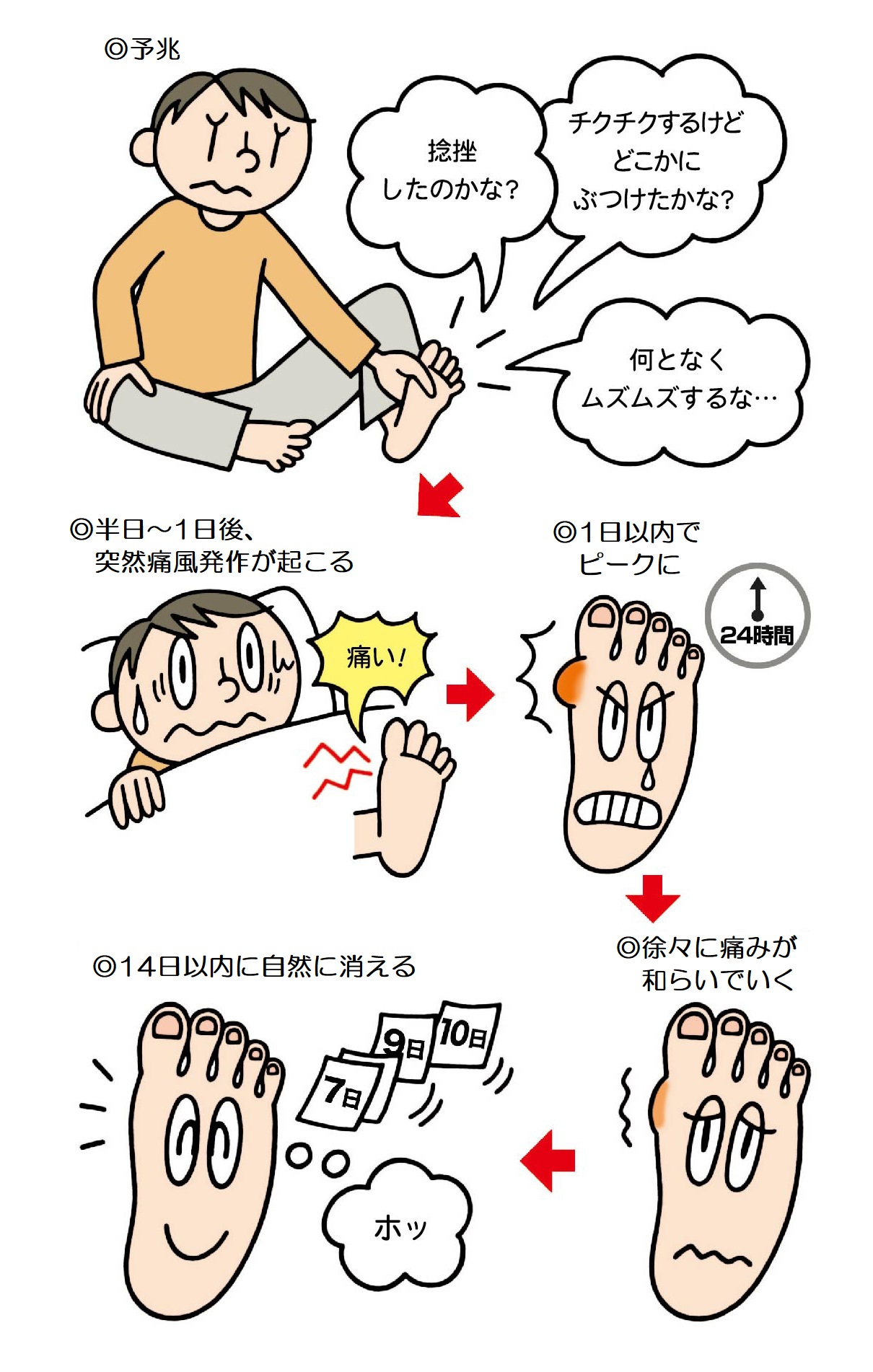 痛風発作の進行