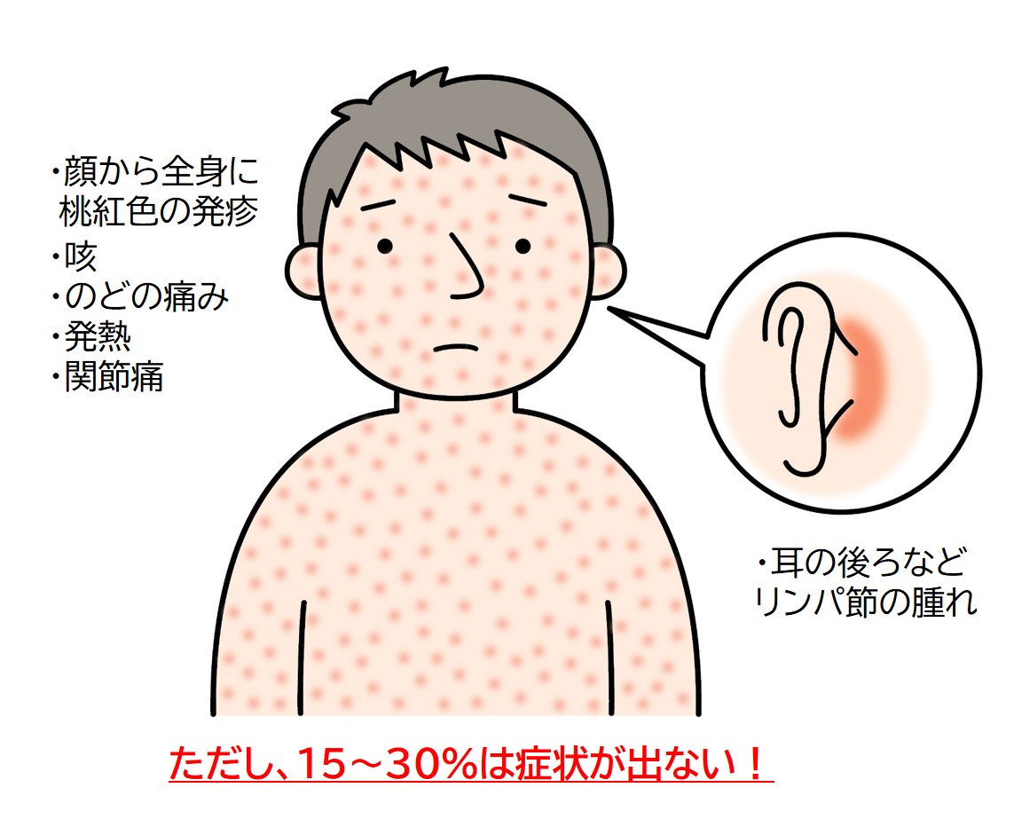 風疹の症状には顔から全身に桃紅色の発疹、耳の後ろなどリンパ節の腫れ、咳やのどの痛み、発熱、関節痛などが挙げられますが、感染者の15～30％ははっきりと症状が出ない。