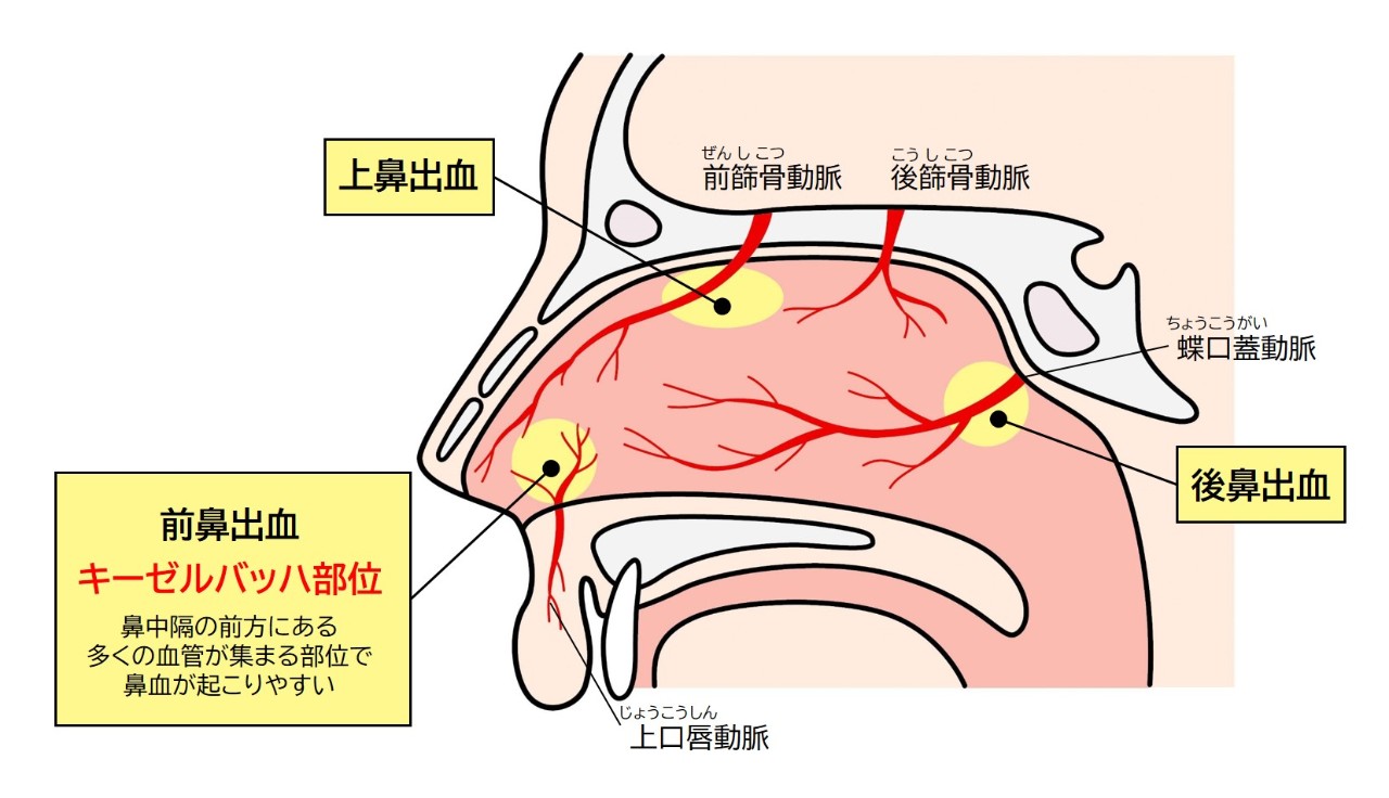 鼻血は起こる場所によって、キーセルバッハ部位からの前鼻出血、上鼻出血、後鼻出血に分けられる
