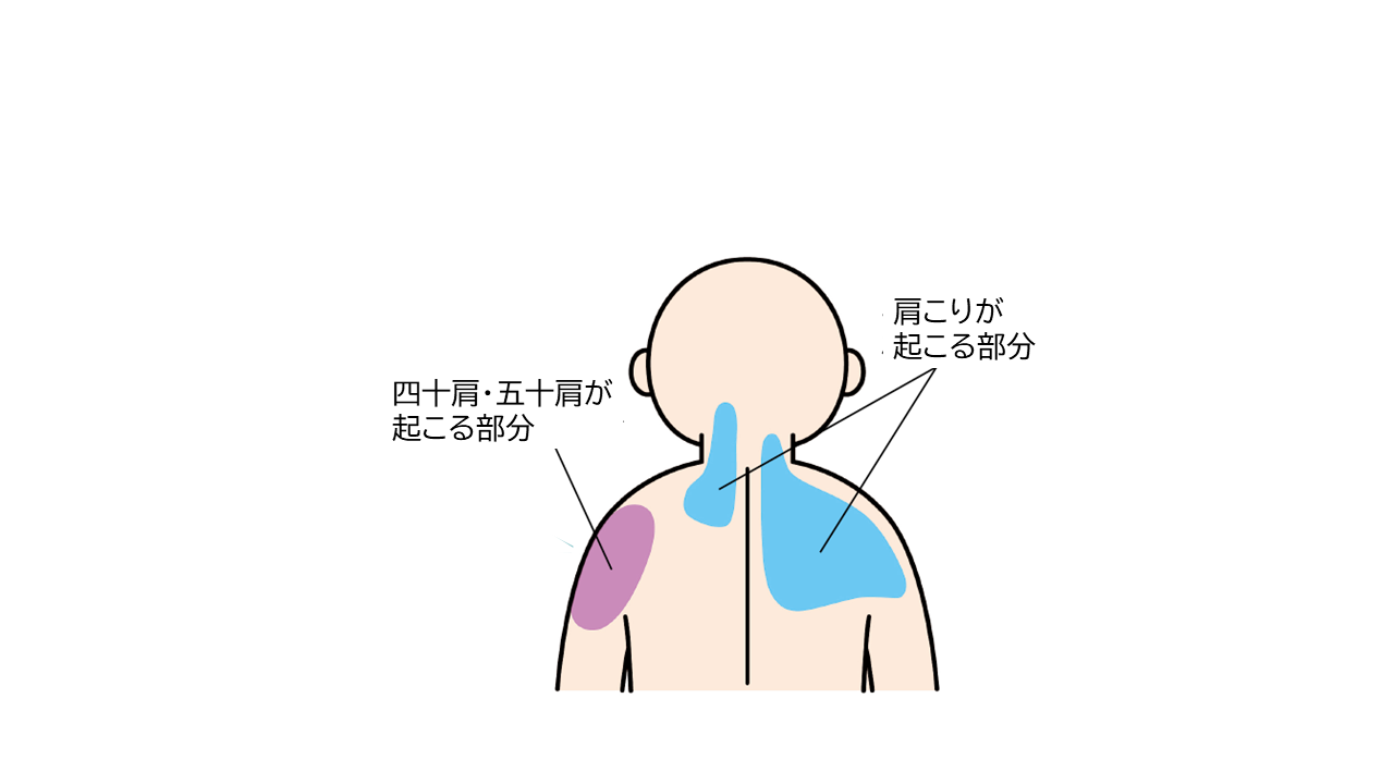 四十肩・五十肩が起こる部分と肩こりが起こる部分の違い