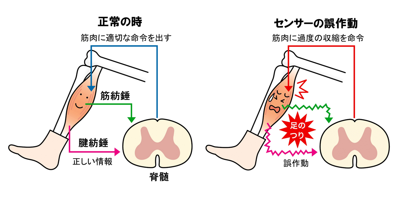 筋肉の収縮を感知するセンサーの誤作動でふくらはぎがつる（こむら返りが起こる）