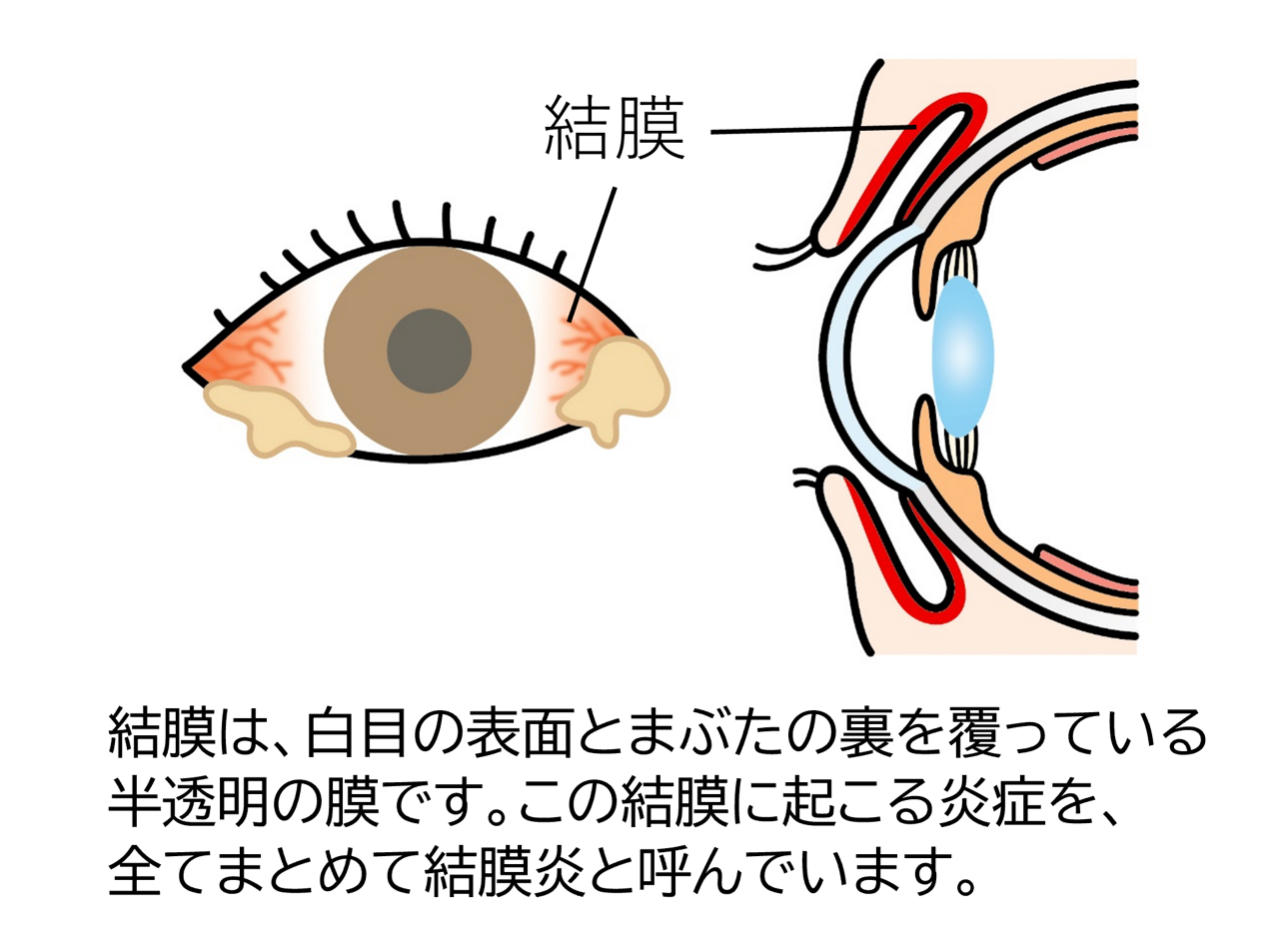 結膜は、城目の表面とまぶたの裏を覆っている半透明の膜のことです。結膜に起こる炎症、全てまとめて結膜炎と呼んでいます。